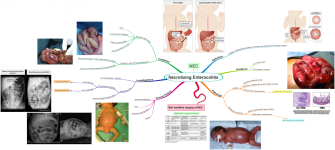 Click image for larger version  Name:	Necrotizing Enterocolitis.png Views:	184 Size:	744.1 KB ID:	1069