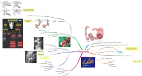 Click image for larger version  Name:	Meconium Ileus.png Views:	2 Size:	595.9 KB ID:	2244