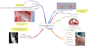 Congenital Diaphragmatic Hernia.png