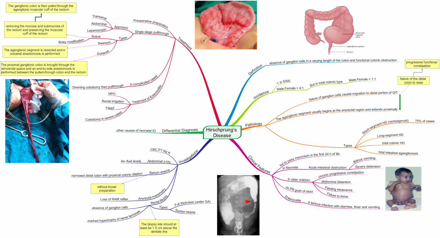 Click image for larger version  Name:	Hirschprung’s Disease.png Views:	82 Size:	776.0 KB ID:	136