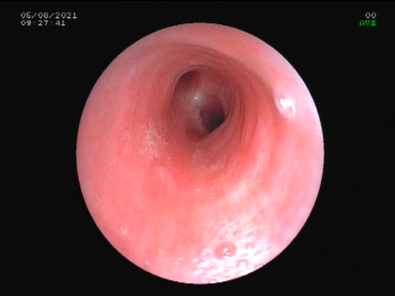 bronchoscopy , no compression
