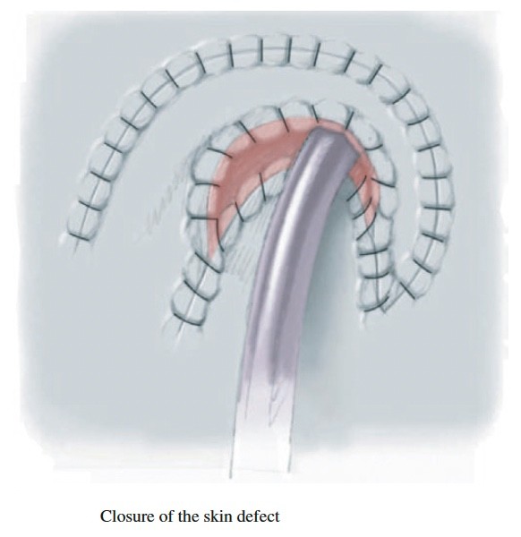 Malon procedure for ACE and Mitrofanoff procedure for CIC - Pediatric ...